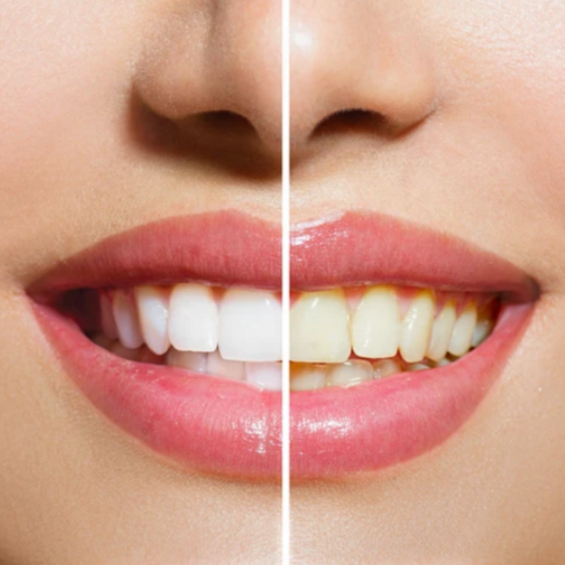 Teeth Whitening at My Smile Dental
