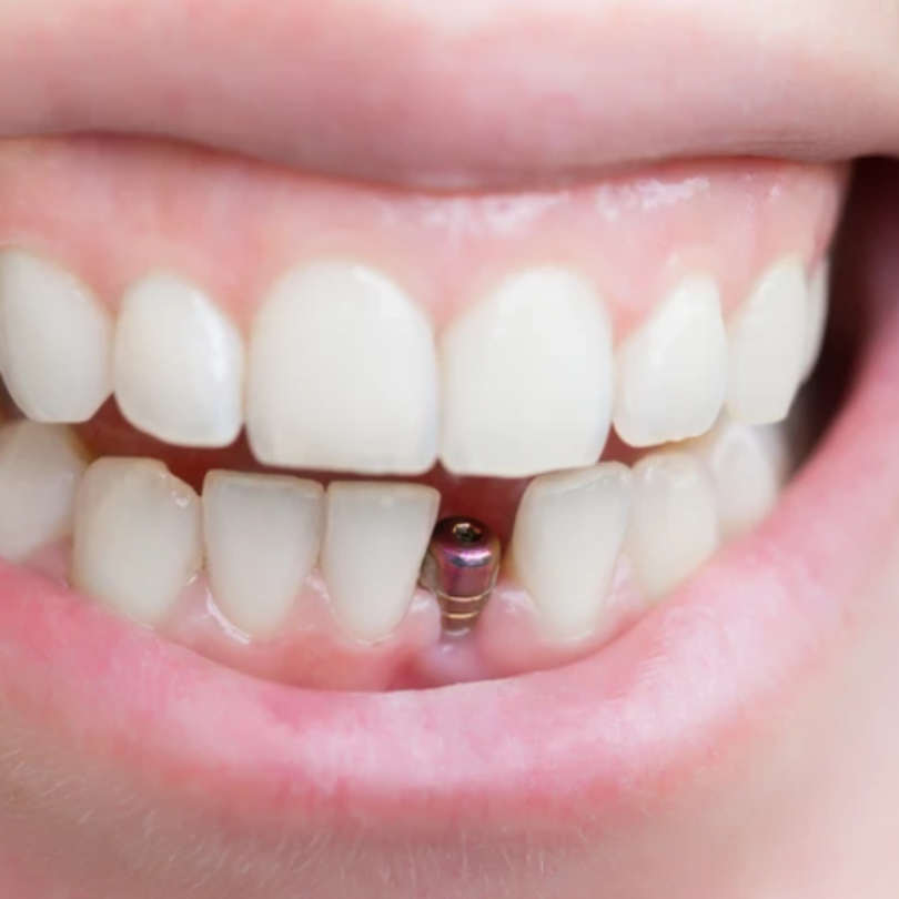 " Single Dental Implant