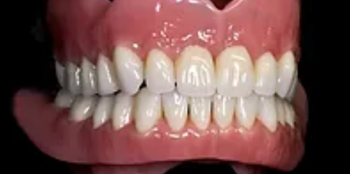 Complete Denture for Missing Teeth
