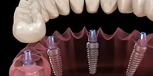 Implant Fixed Supported Bridges