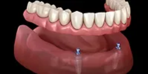 Dental Stabilization