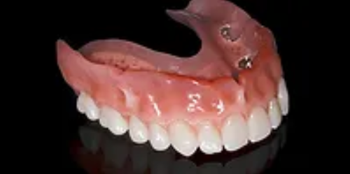 Removable Implant Supported